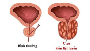 U xơ tuyến tiền liệt