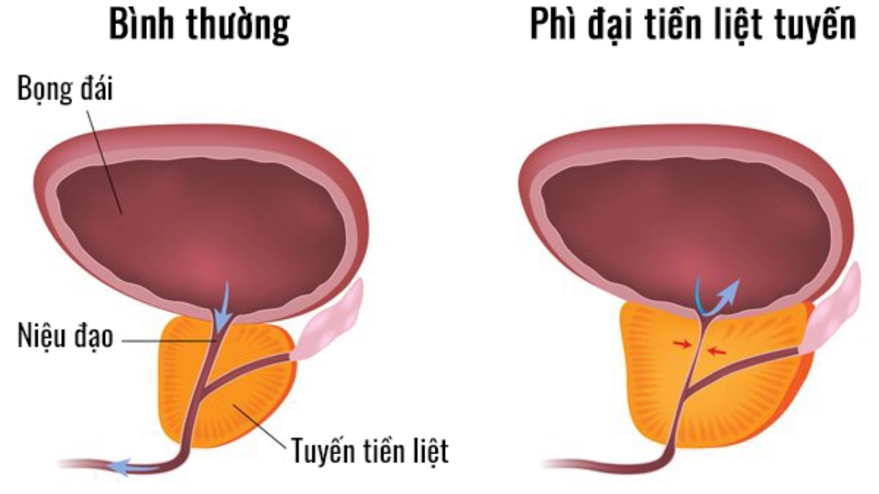 Phì đại tuyến tiền liệt và cách chữa phì đại tuyến tiền liệt.