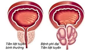 Phì đại tuyến tiền liệt