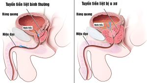 U xơ tuyến tiền liệt