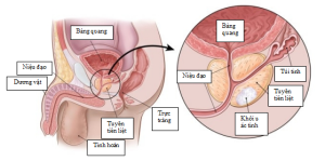 Ung thư tuyến tiền liệt