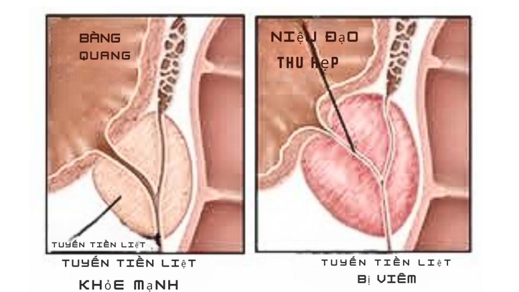 Bị viêm tuyến tiền liệt