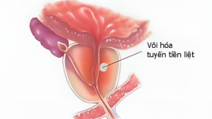 Vôi hóa tuyến tiền liệt.