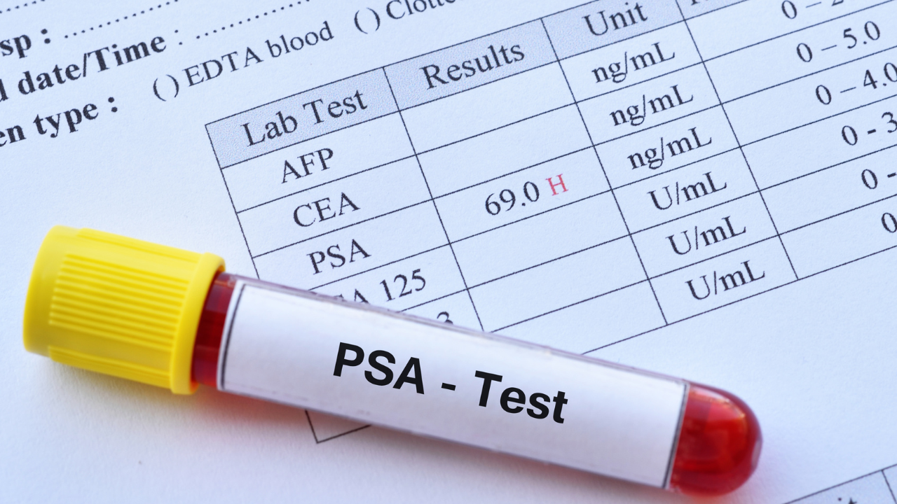 Xét nghiệm Máu PSA Chẩn đoán ung thư tuyến tuyền liệt