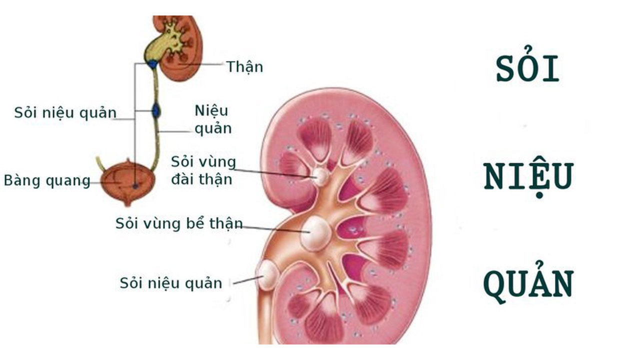 Sỏi niệu quản