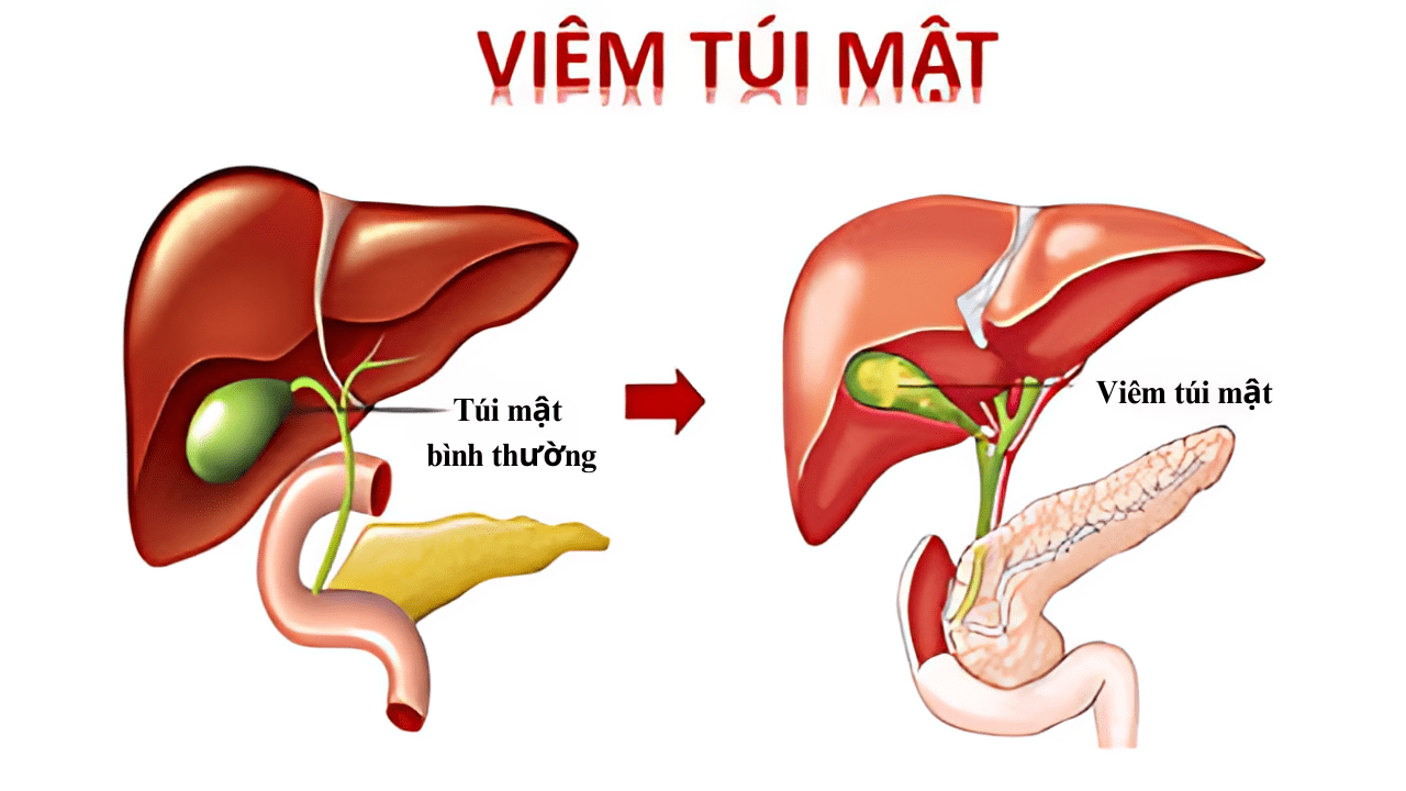 Viêm túi mật